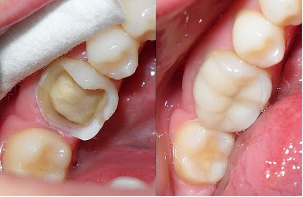 Bọc răng sứ cho răng bị sâu 2