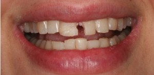 Cách bảo vệ răng sứ bền đẹp