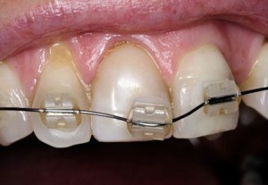 Những vấn đề thường gặp phải khi niềng răng 4