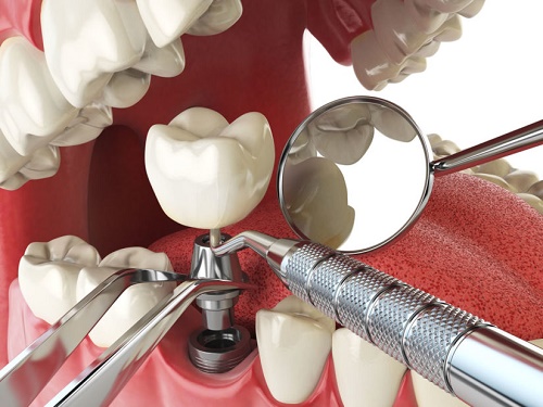 Phương pháp nào trồng răng giả vĩnh viễn? 2