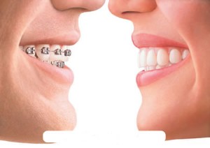 Có cách nào giải quyết hàm răng bị hô? 