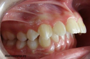 Có cách nào giải quyết hàm răng bị hô? 