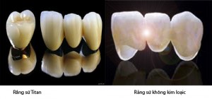 Làm sao có thể kéo dài tuổi thọ của răng sứ