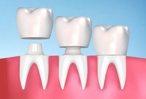Làm đẹp cho hàm răng bằng cách bọc răng sứ 2