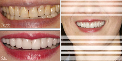 Làm đẹp cho hàm răng bằng cách bọc răng sứ 1