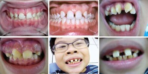 Khi nào nên cho trẻ niềng răng 1