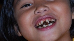 Khi nào nên cho trẻ niềng răng 2