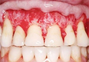 Bệnh viêm nướu có thể làm mất răng hay không? 