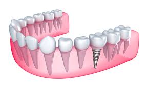 Phục hình răng giả với implant và răng sứ
