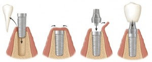 Bảo vệ xương hàm khi mất răng bằng giải pháp implant