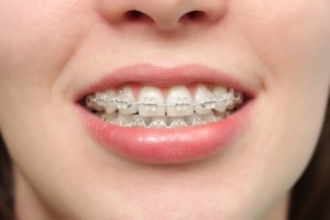 Liệu niềng răng thẩm mỹ có làm giảm tuổi thọ không?