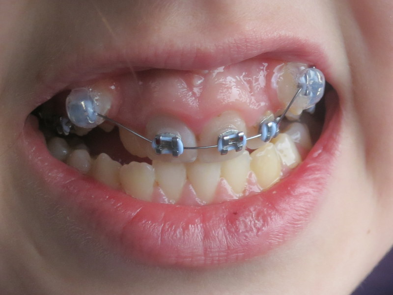 Một vài vấn đề liên quan đến trẻ khi niềng răng