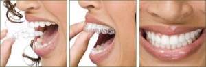 Niềng răng invisalign và những điều cần biết