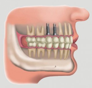Các kỹ thuật phục hình răng giả thường gặp