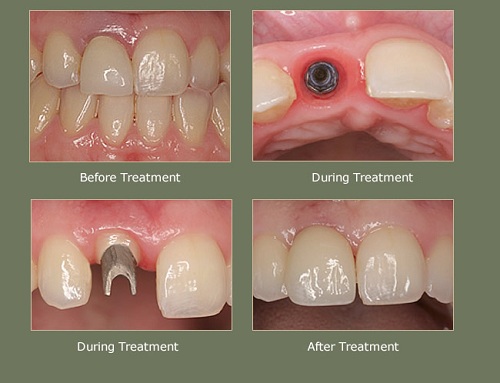 Lý do lựa chọn phục hình răng implant