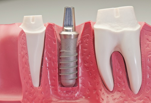 Tại sao lựa chọn cấy ghép implant thay thế răng