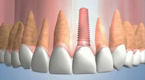 Implant - Nâng cao chất lượng cuộc sống khi bị mất răng