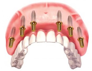 Implant nâng đỡ cầu răng khi mất răng toàn hàm