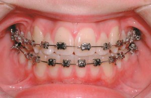 Liệu niềng răng bác sĩ có chỉ định nhổ răng không?