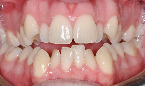Phương pháp niềng răng mọc lệch lạc hiệu quả tốt 1