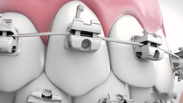 Phương pháp niềng răng mọc lệch lạc hiệu quả tốt 2