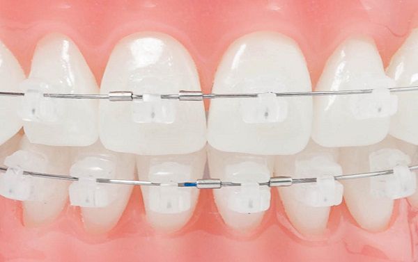 Phương pháp niềng răng mọc lệch lạc hiệu quả tốt 3