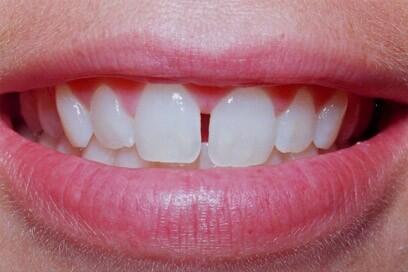 Niềng răng thưa - Phương pháp an toàn hiệu quả 1