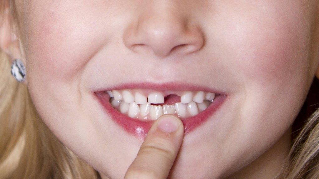 Trồng răng giả giá bao nhiêu là chuẩn nhất? 1