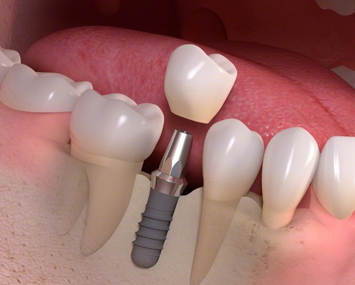 Trồng răng hàm có đau không? 2