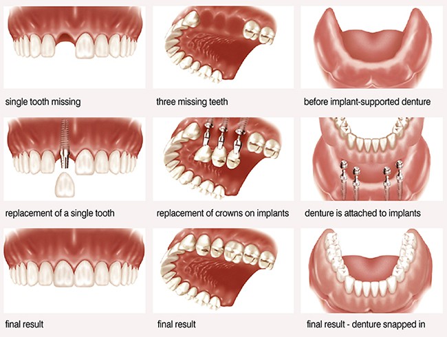Cắm Implant răng cửa là như thế nào? 2