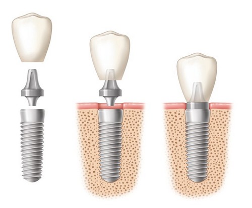 Thực hiện cấy ghép răng Implant có đau không? 1
