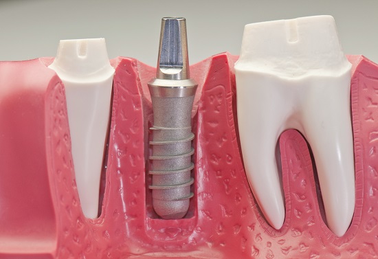 Thực hiện cấy ghép răng Implant có đau không? 2