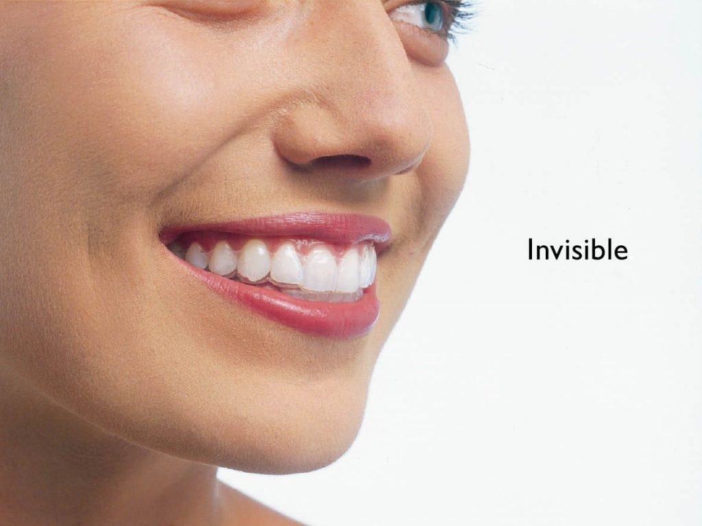 Những điều cần biết về niềng răng không mắc cài Invisalign 1
