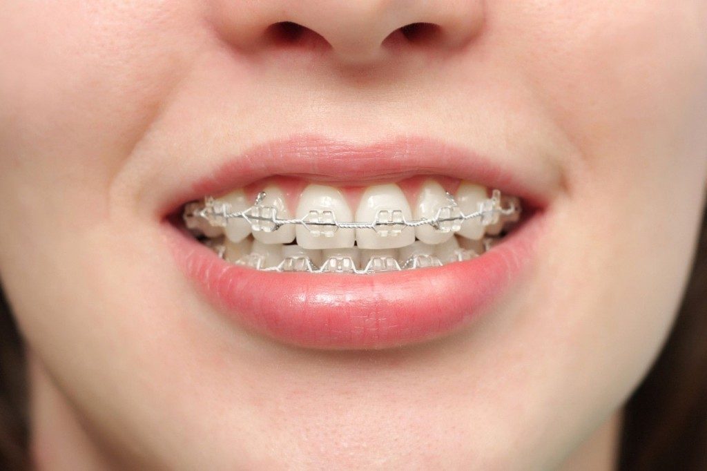 Niềng răng ở đâu tốt nhất trên ba vùng miền? 2