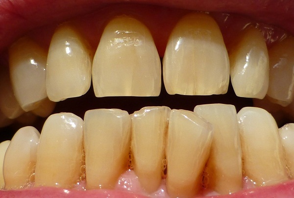 Tẩy trắng răng bằng Laser có hại không? Có biến chứng không? 1