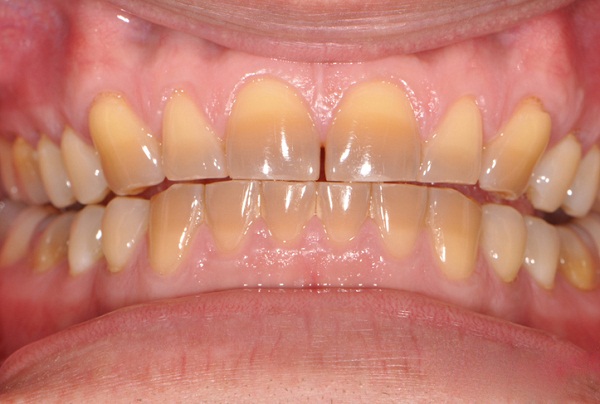 Tìm hiểu về kỹ thuật tẩy trắng răng bị nhiễm Tetracycline 1