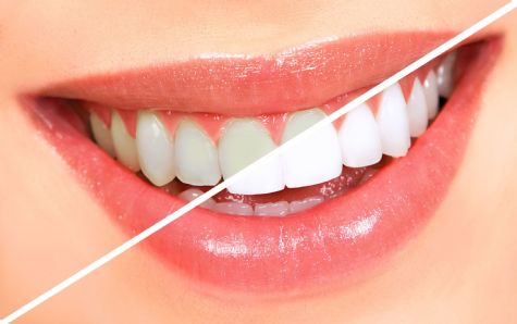 Trút bỏ lo lắng - Tẩy trắng răng có đắt không tại nha khoa Đăng Lưu? 1