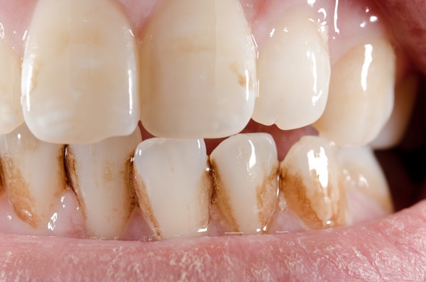 Tẩy trắng răng có nguy hiểm không? Khi thực hiện cần lưu ý gì? 1