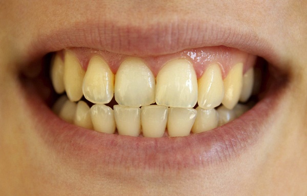 Tẩy trắng răng nha khoa - Giải pháp cho bạn hàm răng trắng sáng 2