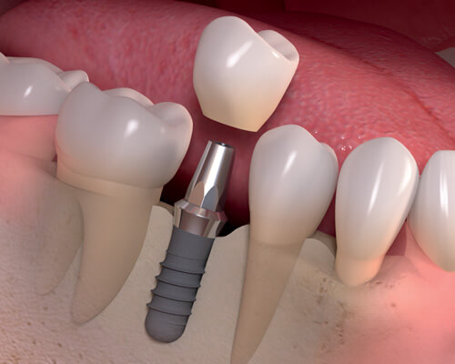 Trồng răng Implant có đau không và nguy hiểm không? 2