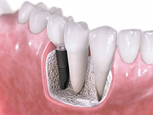 Những phương pháp trồng răng sứ thẩm mỹ hiện nay 2