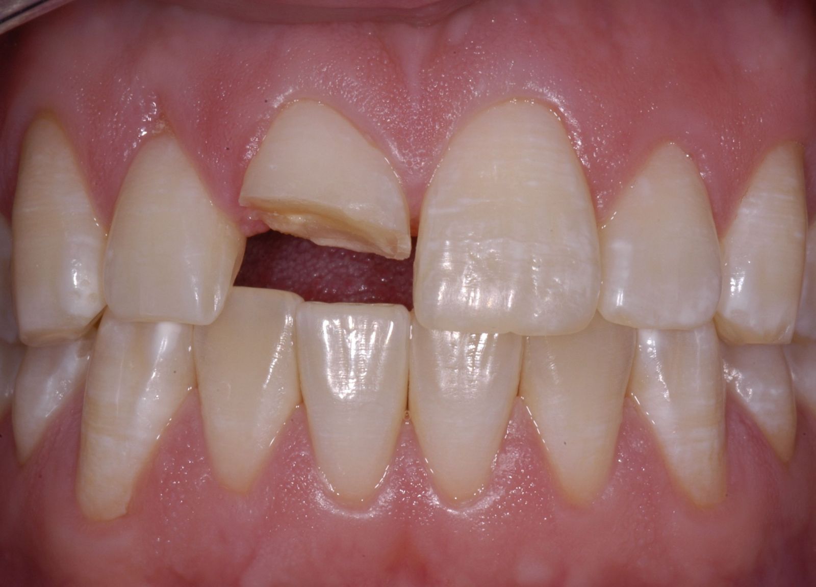 Kỹ thuật bọc răng sứ cho răng cửa 1