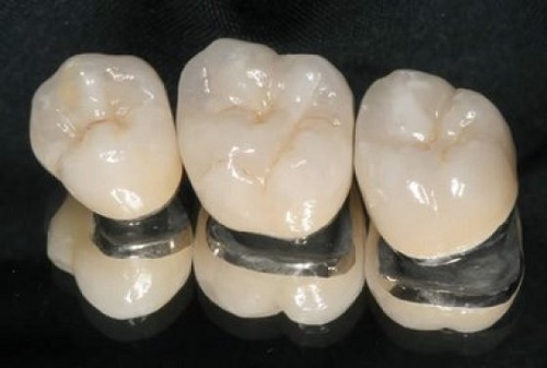 Kỹ thuật bọc răng sứ kim loại thường có tốt không? 1