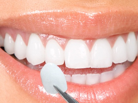 Bọc răng sứ cercon giá bao nhiêu? 2