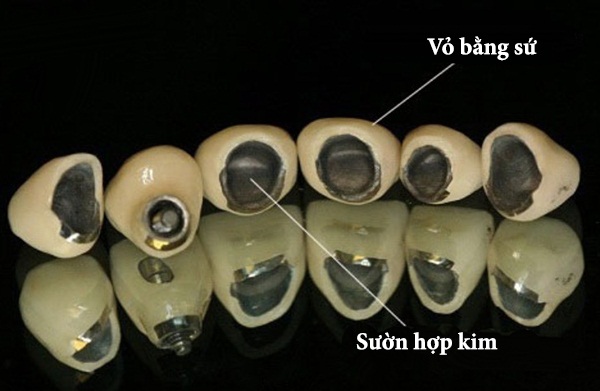 Thông tin về kỹ thuật bọc răng sứ titan 1