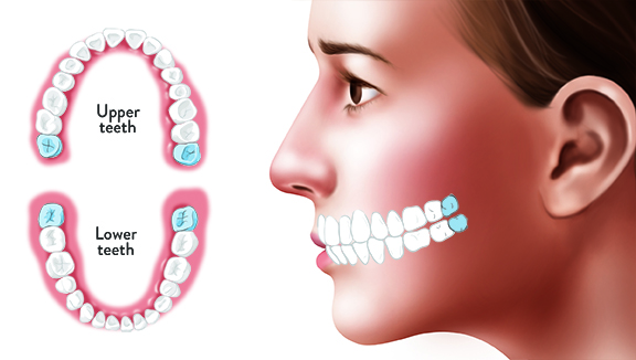 5 dấu hiệu mọc răng khôn
