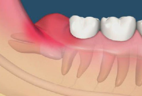 Tìm nguyên nhân đau răng khôn và cách xử lý phù hợp 2