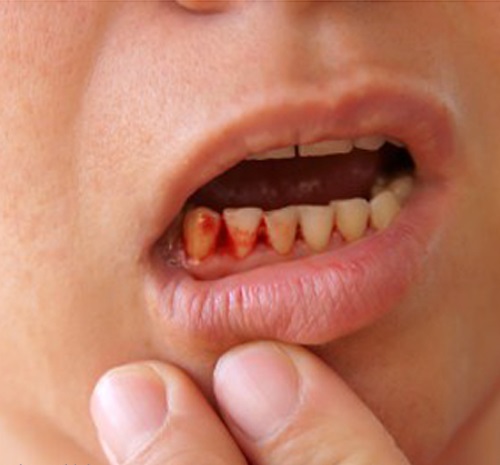 Tìm hiểu nguyên nhân nướu răng bị chảy máu 1