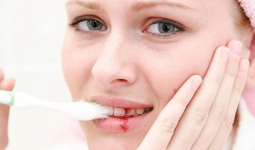 Chảy máu chân răng - Nguyên nhân và cách điều trị 1
