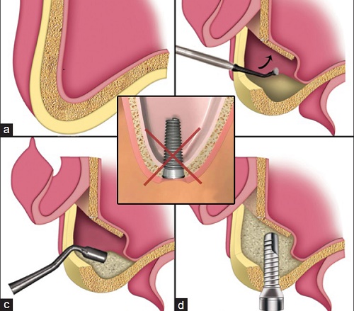 Thông tin về kỹ thuật nâng xoang hàm trong cấy ghép implant 1
